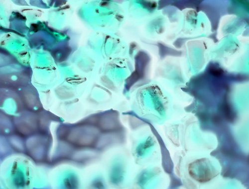 Melanoma Joint IRE-ISG